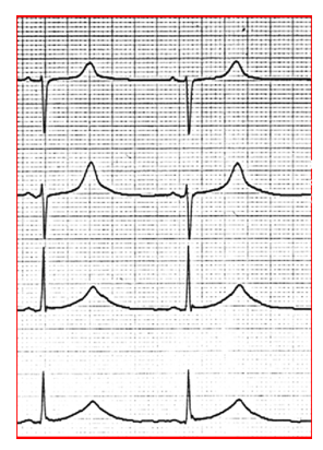 elettrocardiogramma